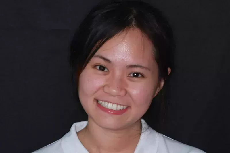 Invisalign Results Invisalign Results