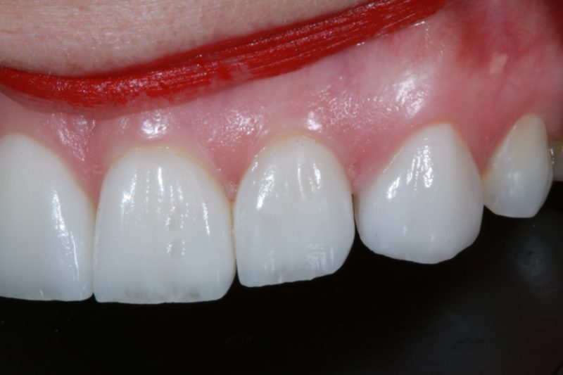After Veneers TKC Dental