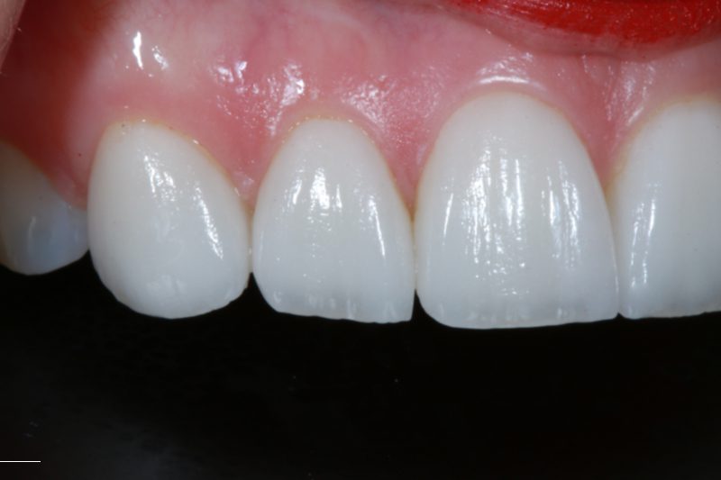 After Veneers TKC dental