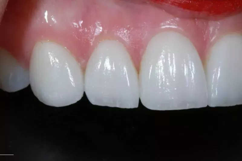 After Veneers TKC dental