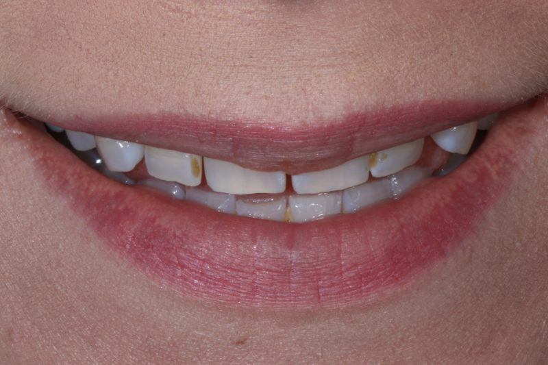 Before veneers TKC Dental