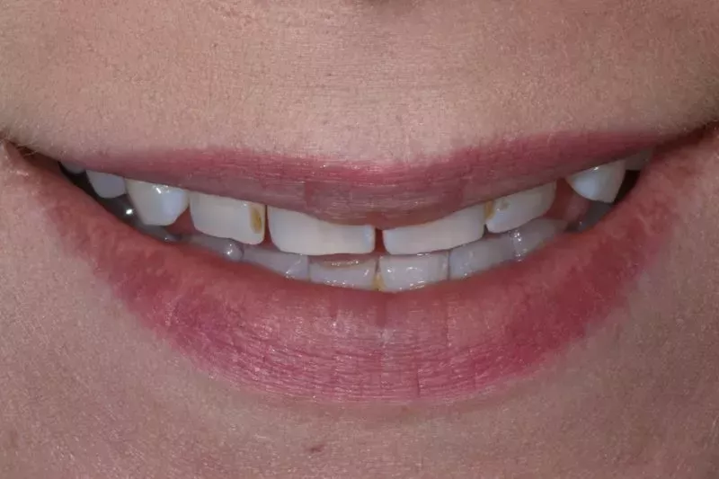 Before veneers TKC Dental