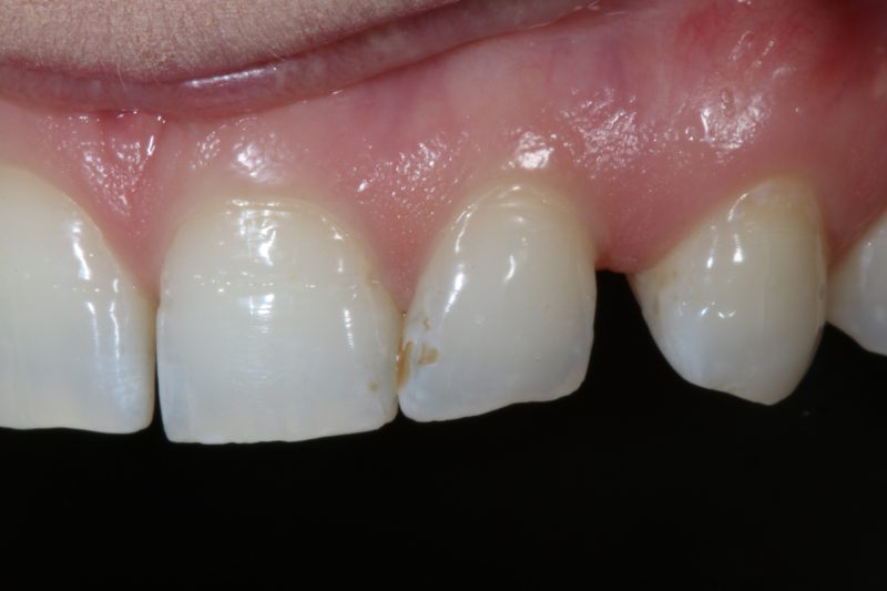 Before veneers TKC Dental