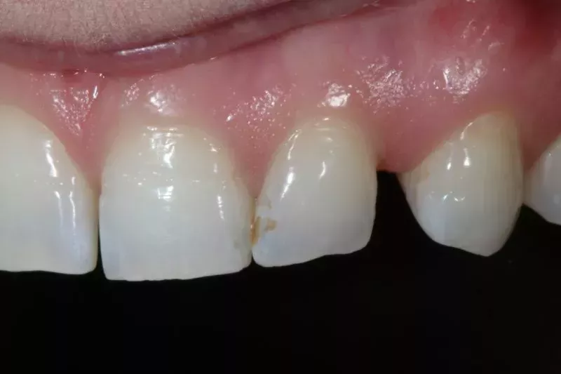 Before veneers TKC Dental