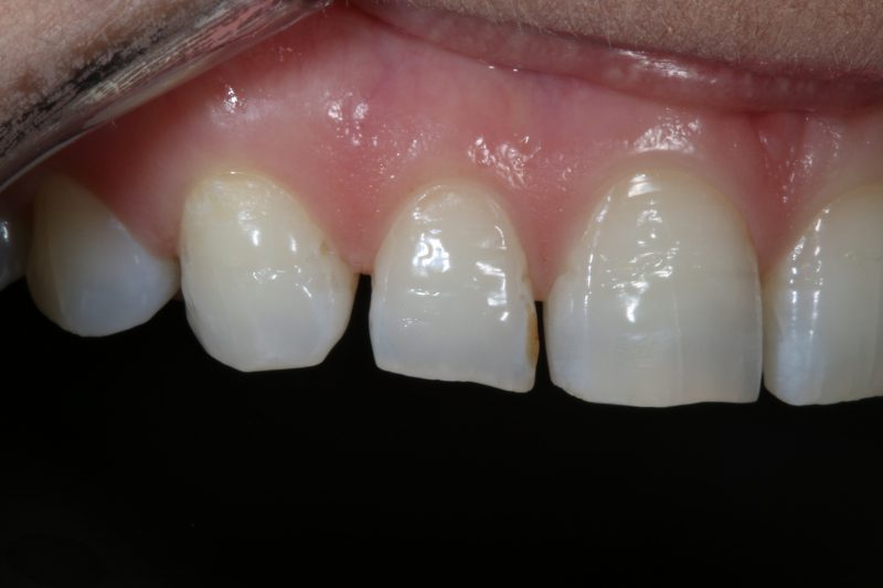 Before Porcelain veneers TKC Dental