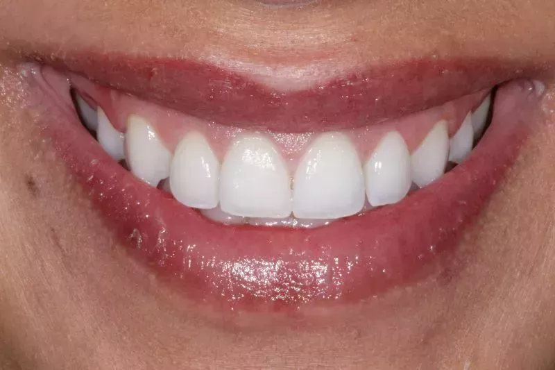 After Gum Contour
