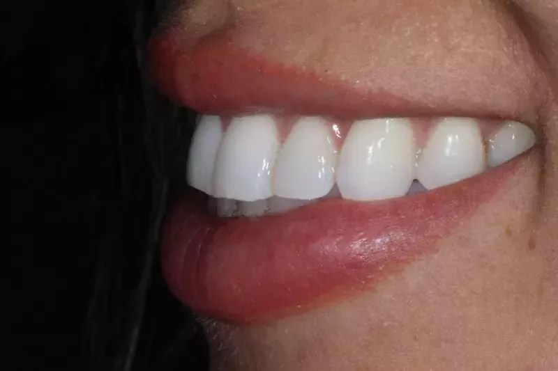 After Invisalign After Invisalign