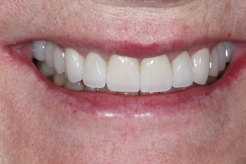 After Veneers TKC Dental