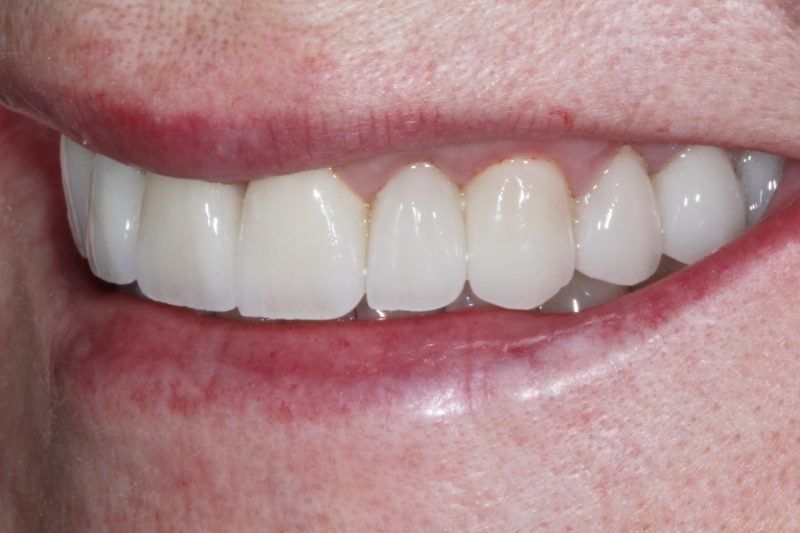 After Veneers TKC Dental