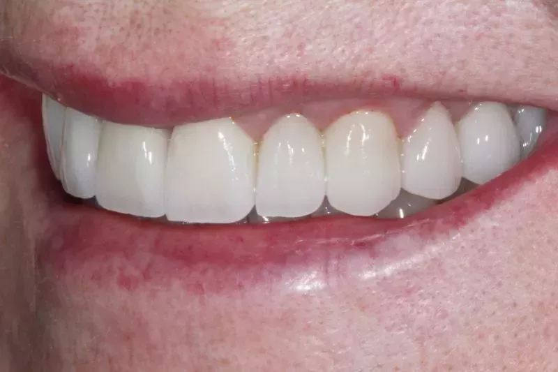 After Veneers TKC Dental
