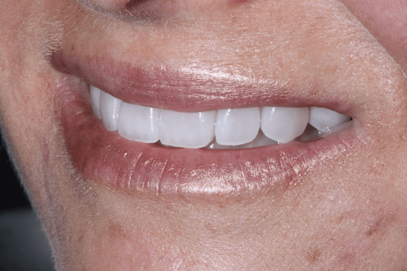 After Veneers The Knightsbridge Clinic