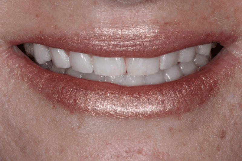After Veneers The Knightsbridge Clinic