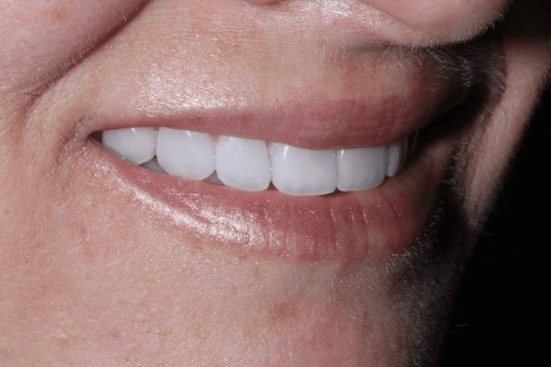 After Veneers The Knightsbridge Clinic