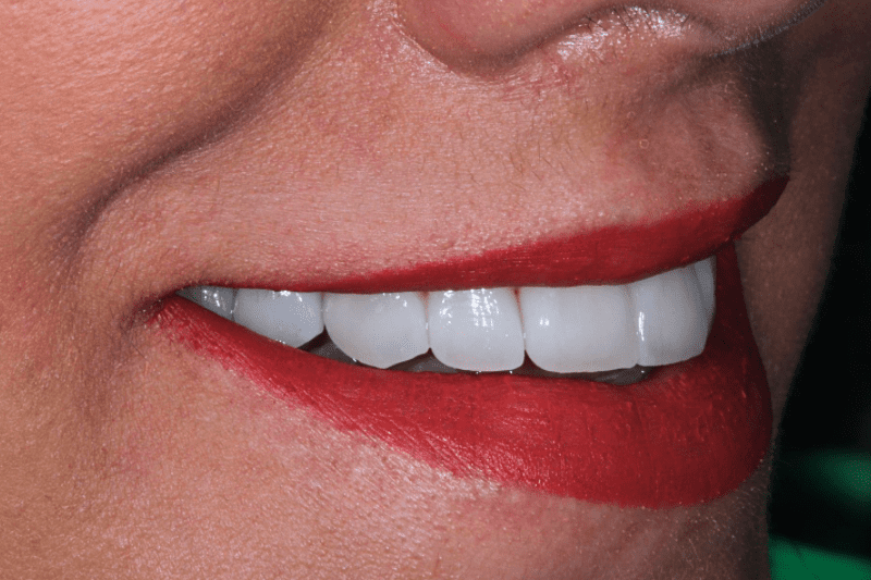 After Porcelain Veneers