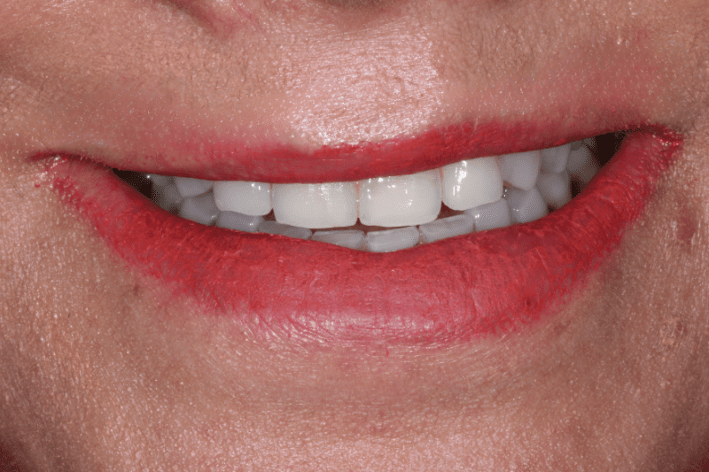 Before Veneers The Knightsbridge Clinic