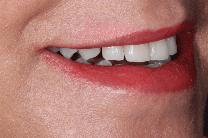 Before Porcelain veneers