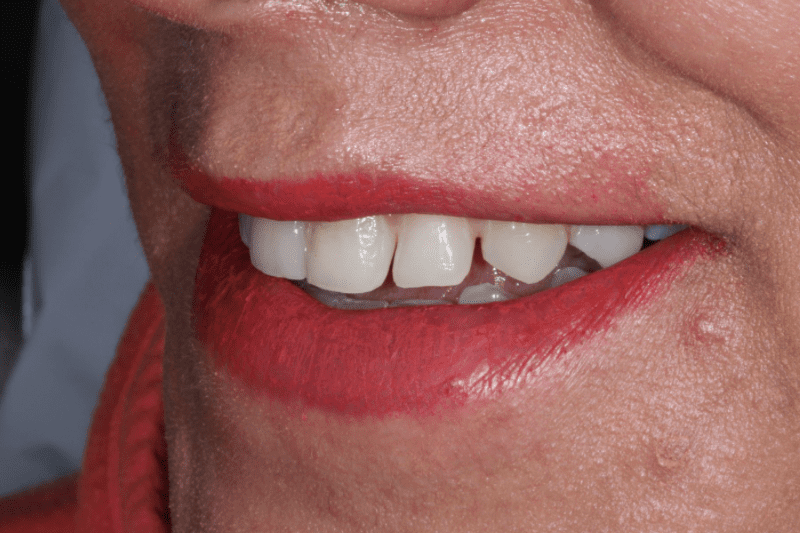 Before Porcelain veneers the difference