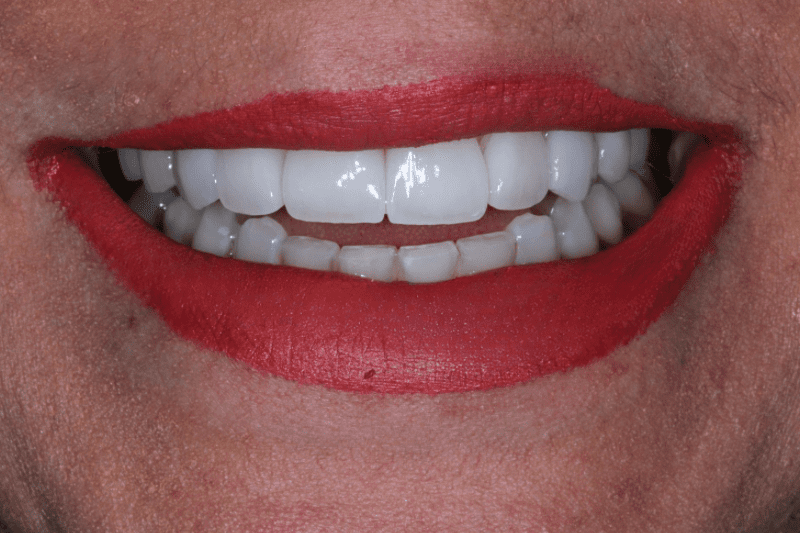 After Veneers The Knightsbridge Clinic