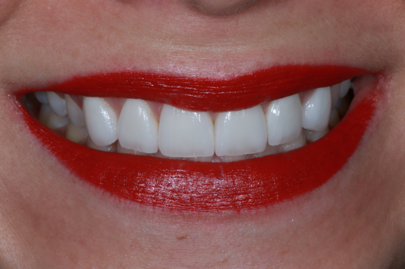 After non cutting veneers