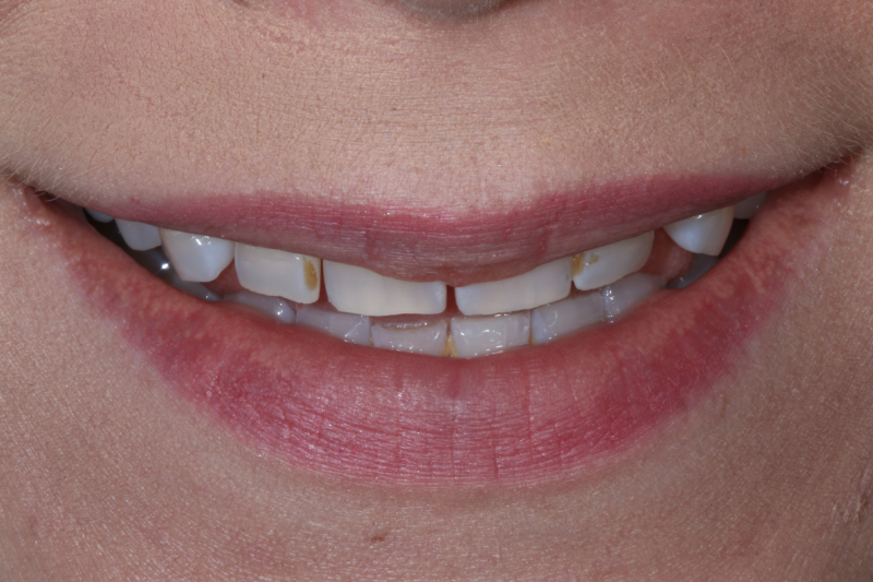 Before Porcelain veneers the difference