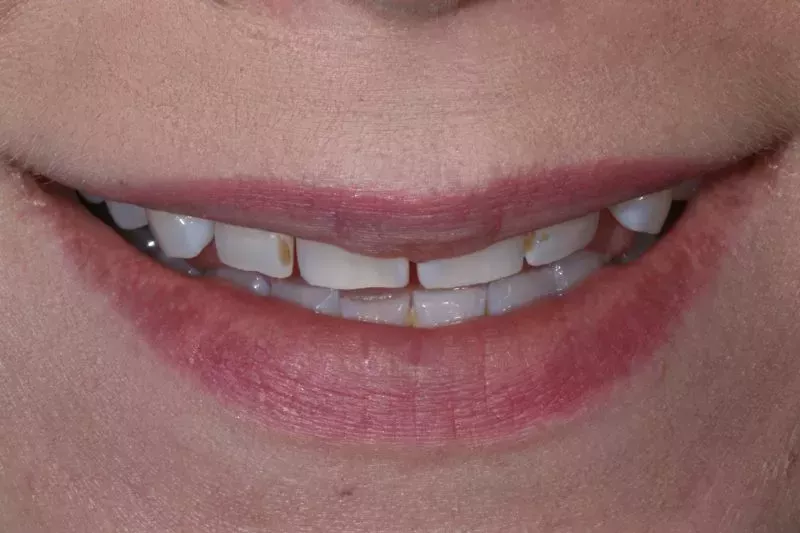 Before Porcelain veneers the difference