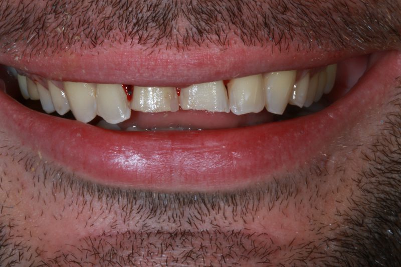 Before Veneers and Invisalign