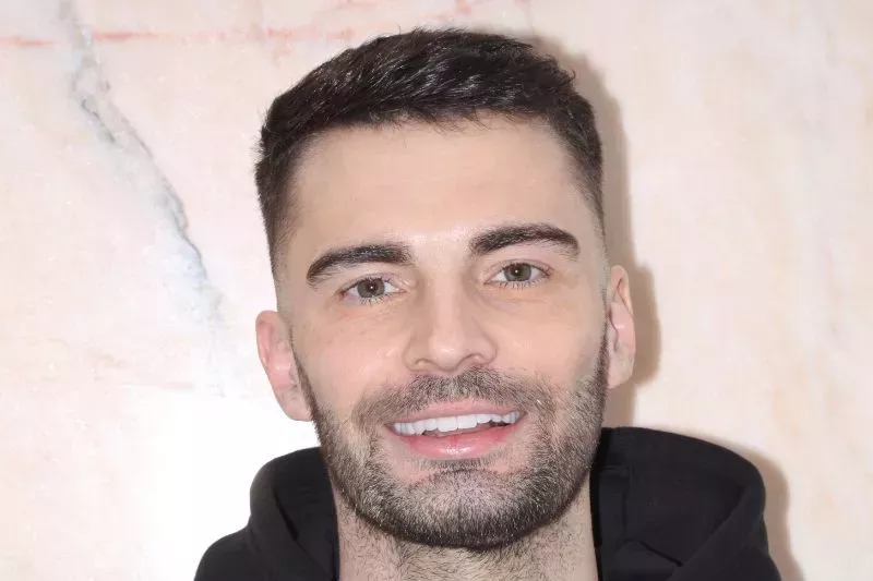 After Porcelain Veneers TKC Dental