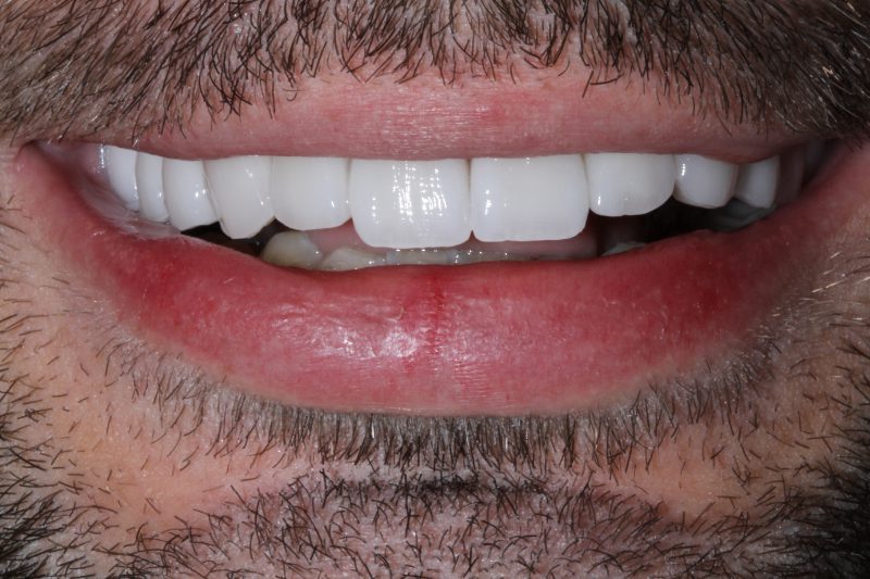 After Veneers and Invisalign