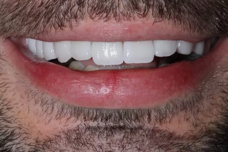 After Veneers and Invisalign