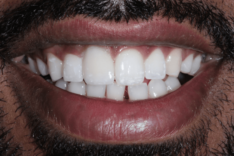 After Cerec Crown