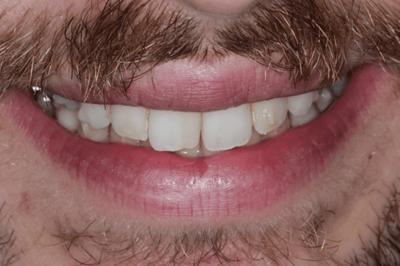 before dental veneers