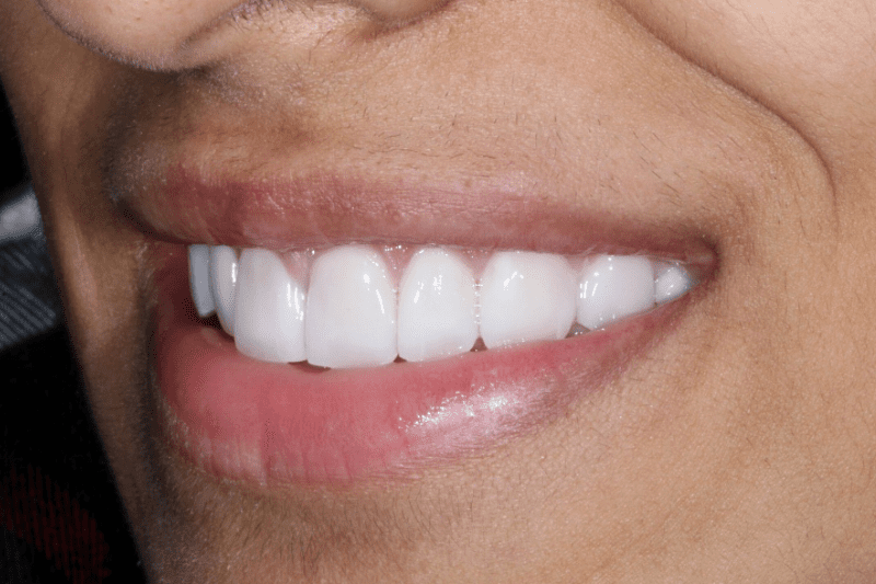After Veneers The Knightsbridge Clinic