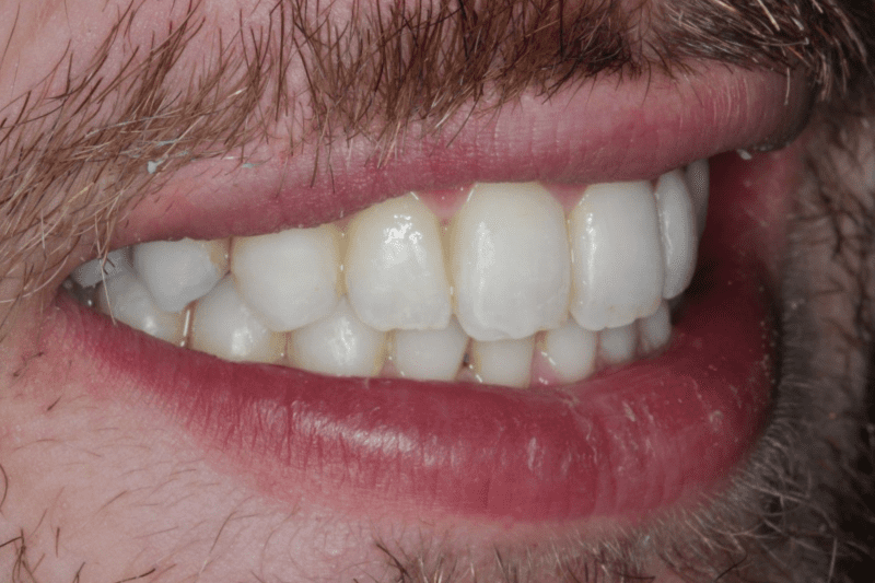 Before veneers Dr Aleem