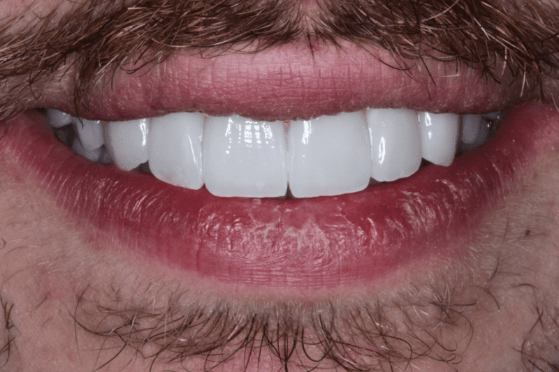 After dental veneers