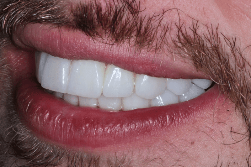 After Veneers The Knightsbridge Clinic