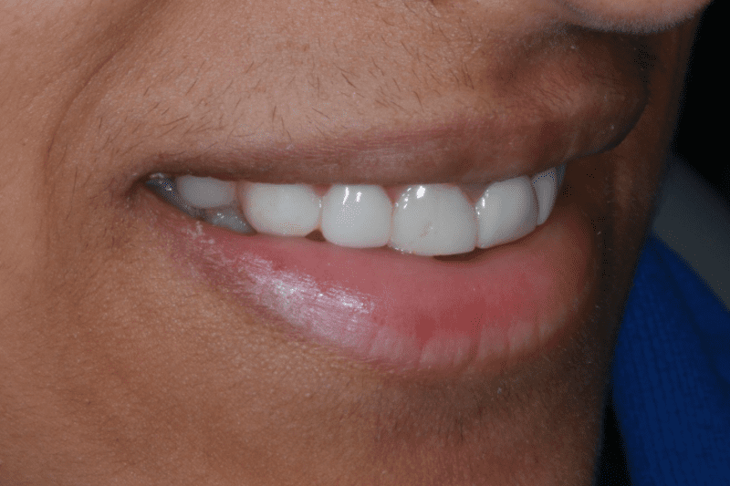 Before veneers Dr Aleem