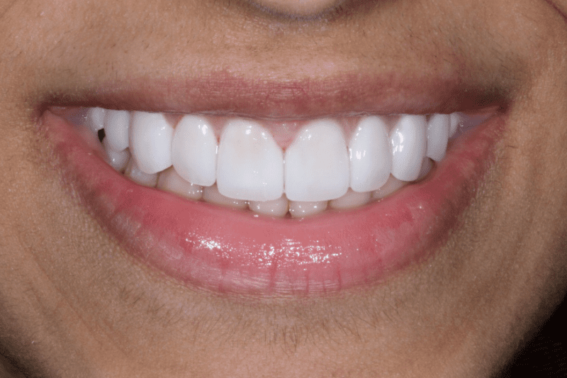 After veneers Dr Aleem