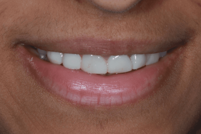 Before veneers Dr Aleem