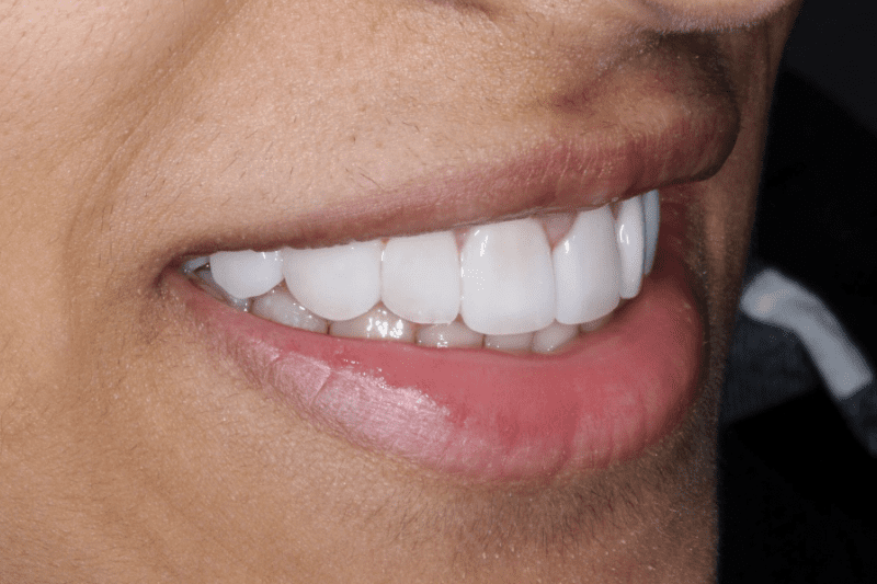 After veneers Dr Aleem