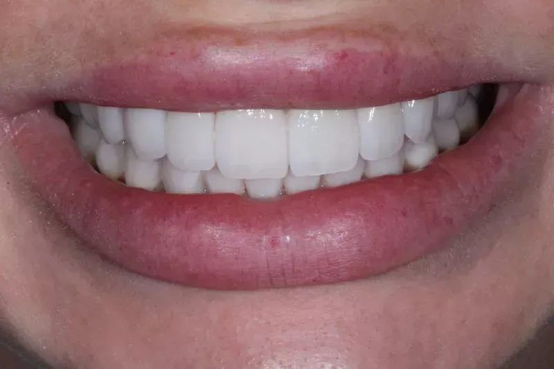 After Veneers The Knightsbridge Clinic porcelain veneers and crowns