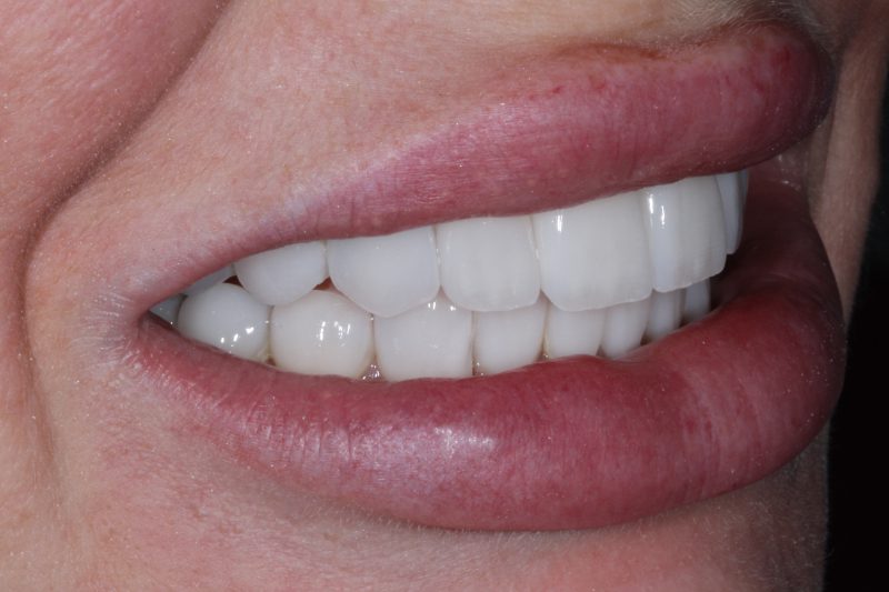 After Veneers The Knightsbridge Clinic