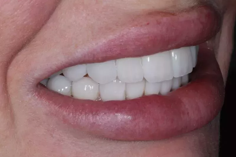 After Veneers The Knightsbridge Clinic