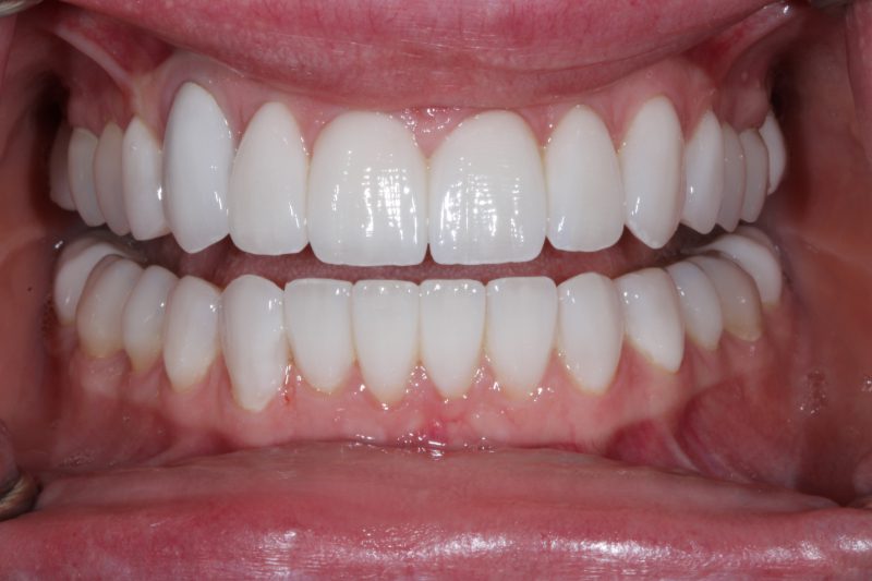 After Veneers The Knightsbridge Clinic