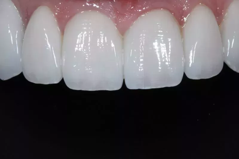 Full Mouth Porcelain Veneers by Dr Aleem