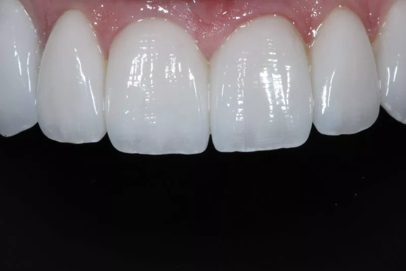thumbnail image 2 of Temporary Teeth Veneers - 3 Sizes, 12 Positions, SL Ceramic For Anterior Whitening 2 of 10