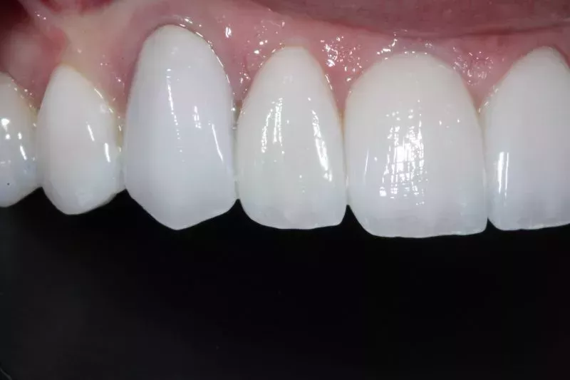 Full Mouth Porcelain Veneers by Dr Aleem
