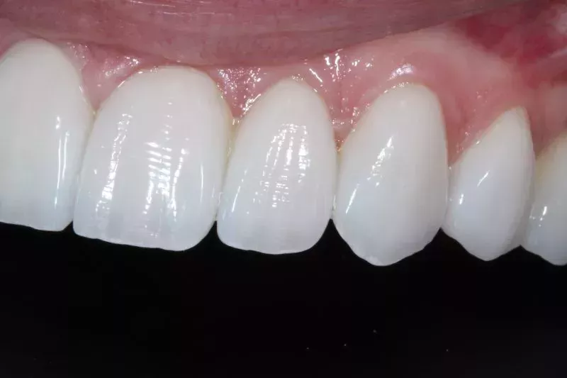 Hand-made Porcelain Veneers by Dr Aleem