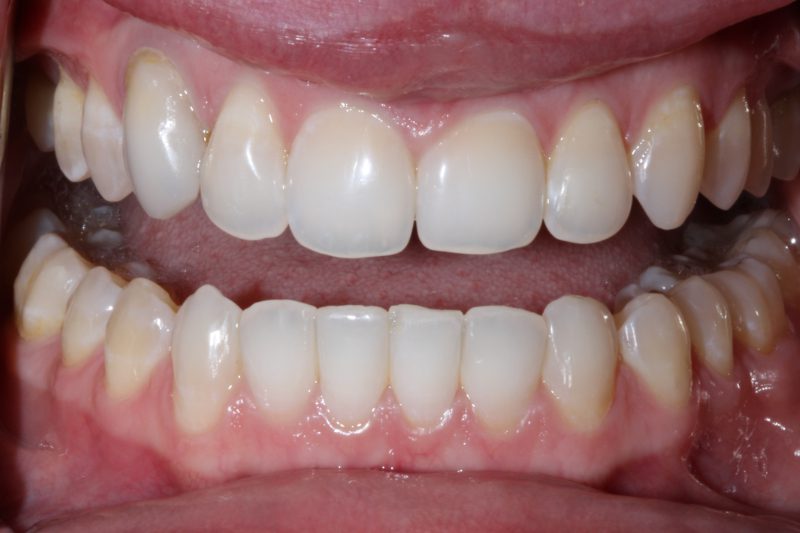 Before veneers Dr Aleem