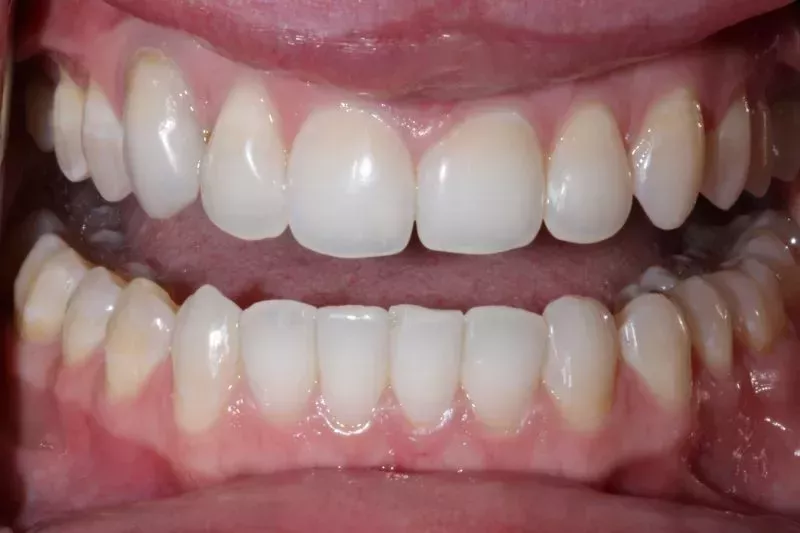 Before veneers Dr Aleem