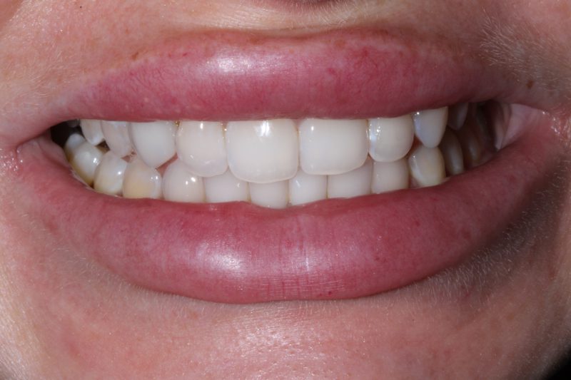 Before veneers Dr Aleem